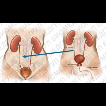 Мочеточниковый стент Memokath051