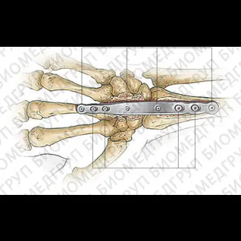 Компрессионная костная пластина для запястья 303100