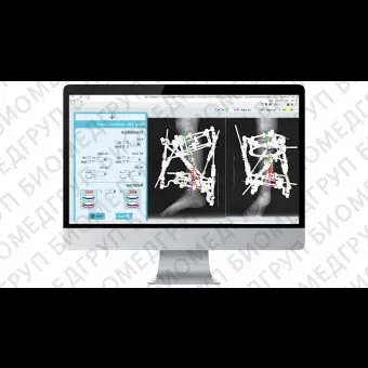 Внешний фиксатор для щиколотки OrthoSUV