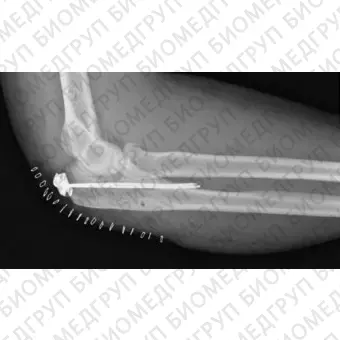 Ортопедическая проволока для контроля протеза бедра Ortholox UHMWPE