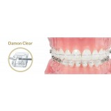 Брекет ортодонтический, модель Damon Clear (латер. в.ч. лев.(+)) 497-6475